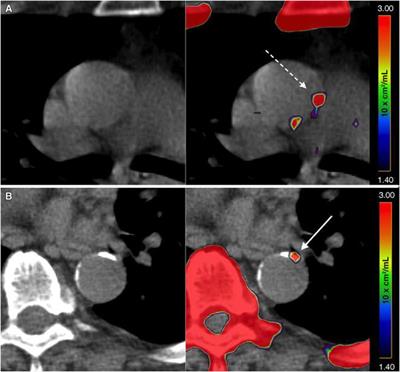 Imaging Atherosclerosis by PET, With Emphasis on the Role of FDG and NaF as Potential Biomarkers for This Disorder